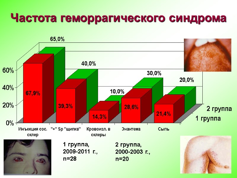 Частота геморрагического синдрома 1 группа, 2009-2011 г.,  n=28 2 группа, 2000-2003 г., 
